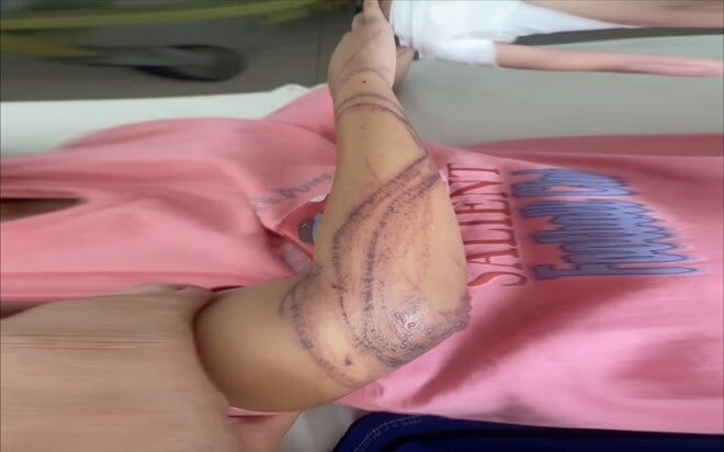 A victim was stung by a jellyfish in Nha Trang beach, causing his entire hand to swell severely. Photo: Huu Long