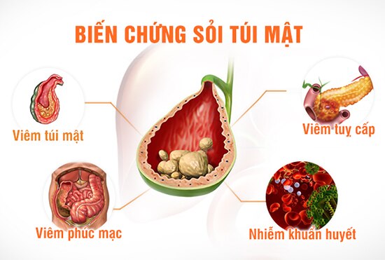 Người phụ nữ 54 tuổi ở Phú Thọ được lấy ra hàng trăm viên sỏi mật sau cơn đau hạ sườn phải- Ảnh 4.