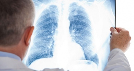 High chance of survival when lung cancer is detected early