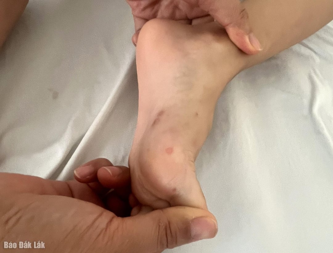 Un enfant de 2 ans décède d'une maladie pieds-mains-bouche