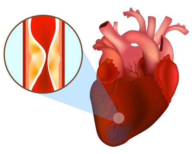 Bệnh nhân bị nhồi máu cơ tim cấp may mắn được cứu sống nhờ nhanh chóng làm việc này- Ảnh 2.