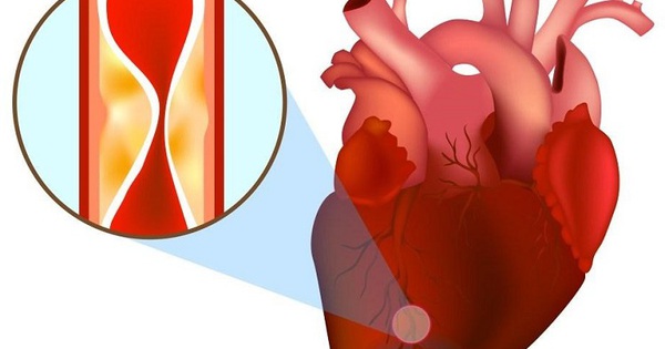 Afortunadamente, un paciente con infarto agudo de miocardio se salvó gracias a esta rápida actuación