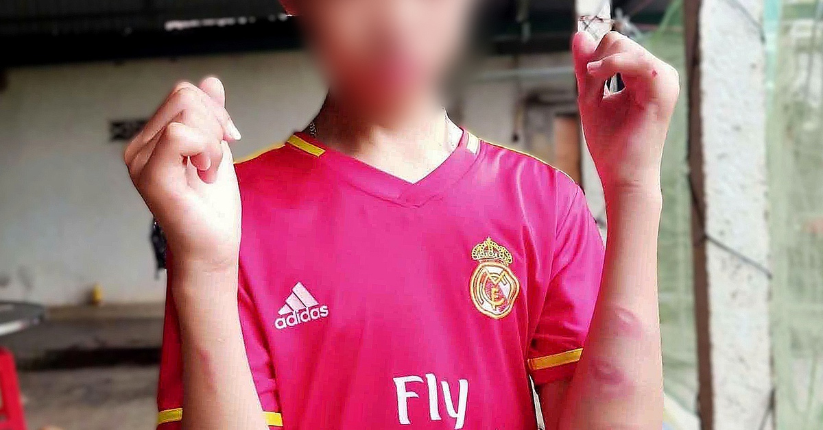 Nam sinh bị nhóm bạn đánh bầm tím trên đường đi học về, trường đang xác minh