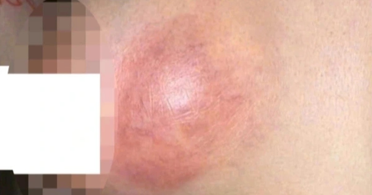 Cô gái trở về từ Malaysia vì ngực rỉ dịch xanh bất thường sau tiêm