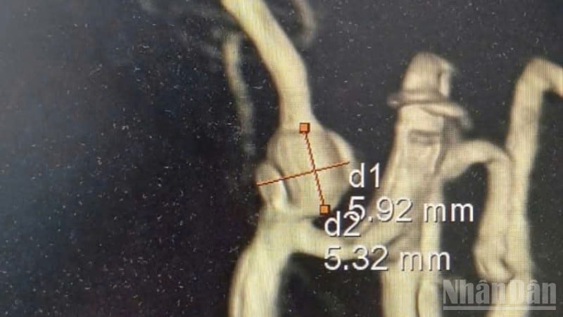 Pasienten Son Phuong ble observert med en aneurisme i arterien vertebral som målte omtrent 5,92 x 5,32 mm.