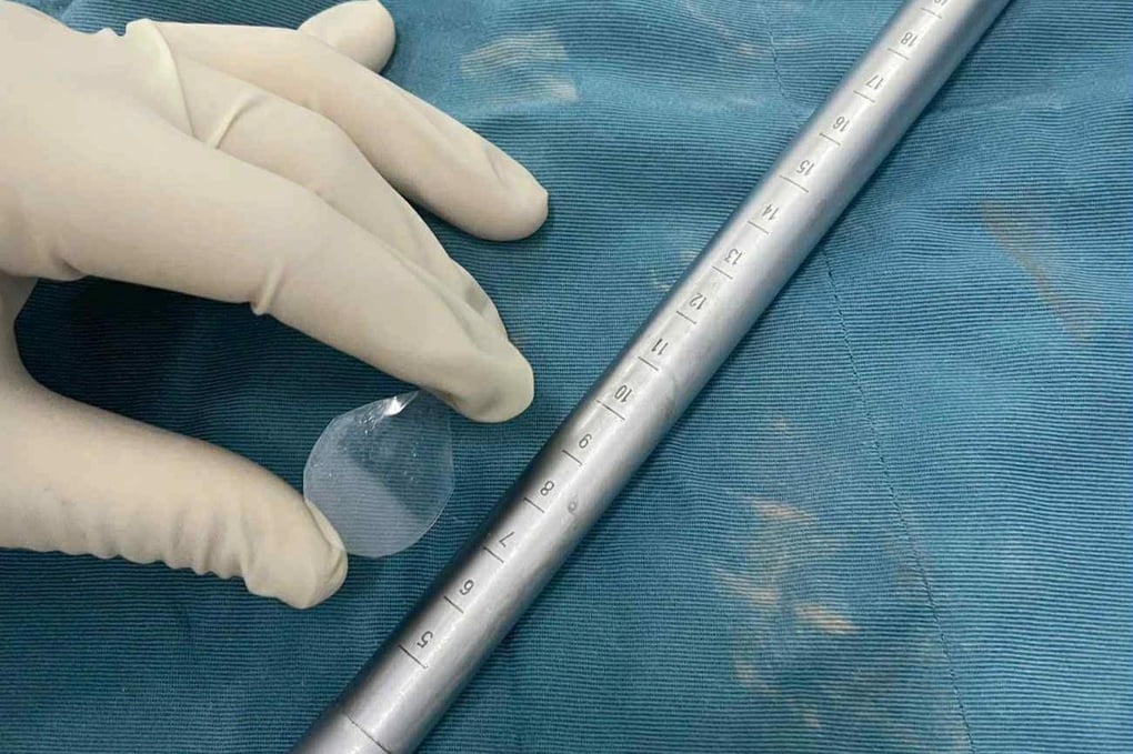 Miếng dị vật trong suốt nguy hiểm ẩn trong cổ họng bé trai - 1