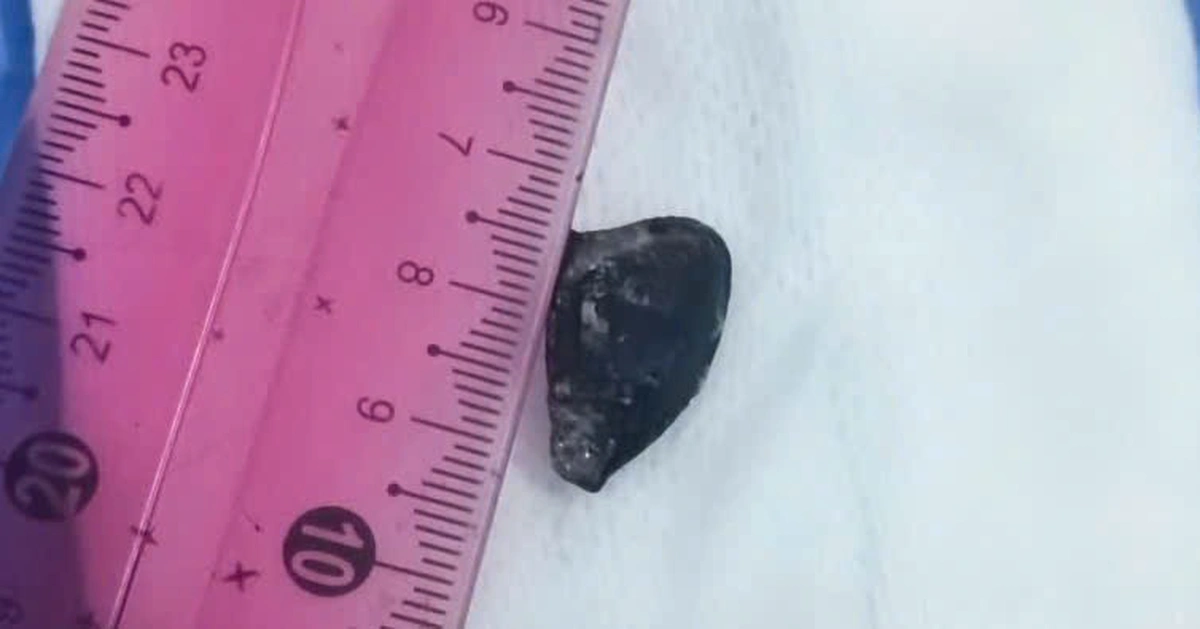 Hạt sapo bị bỏ quên 10 năm trong lòng phế quản