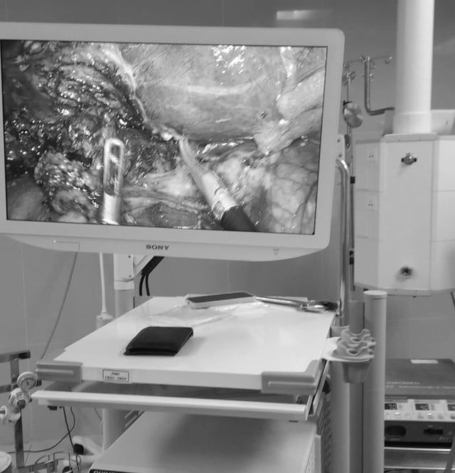 Salvando a vida de um paciente com fístula colecistoduodenal rara com cálculos no ducto biliar comum - Foto 2. Cứu sống bệnh nhân rò túi mật - tá tràng kèm sỏi ống mật chủ hiếm gặp- Ảnh 2.