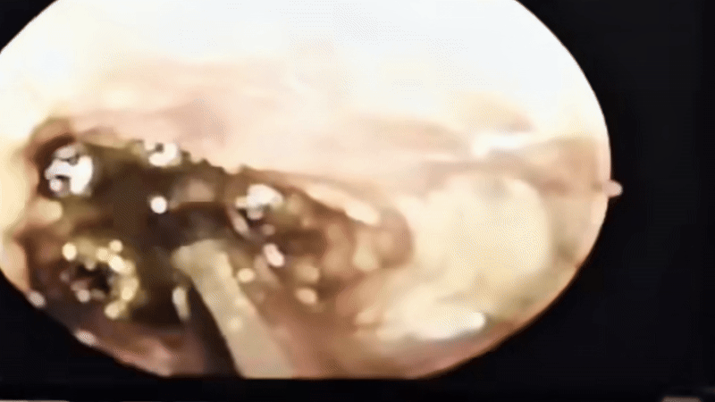 Gắp 5 con giòi sống trong tai người phụ nữ