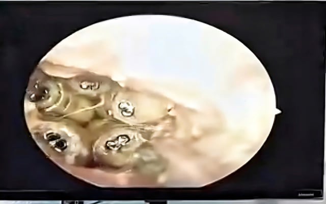 Khánh Hòa: Gắp 5 con giòi sống trong tai bệnh nhân - Ảnh 1.