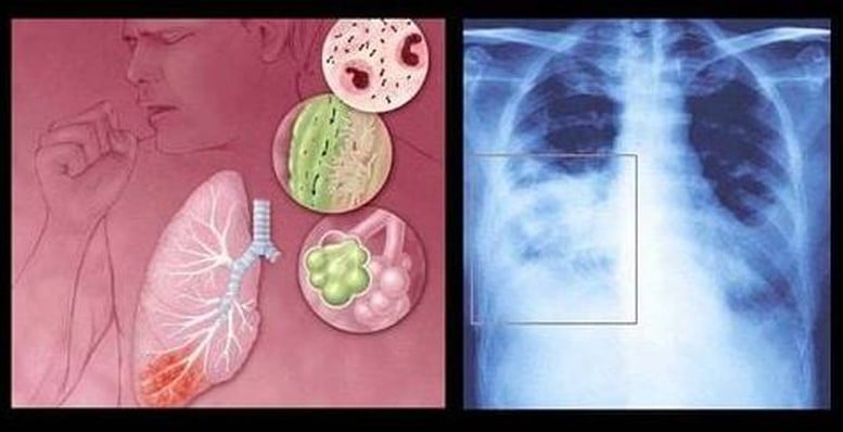 Uniți-vă mâinile pentru a preveni bolile respiratorii cauzate de virusul VSR - Fotografia 1.