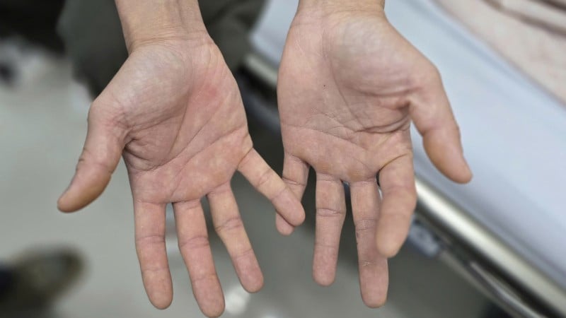 Herr H:s hand var domnad, oförmögen att stänga och förlorade känseln.