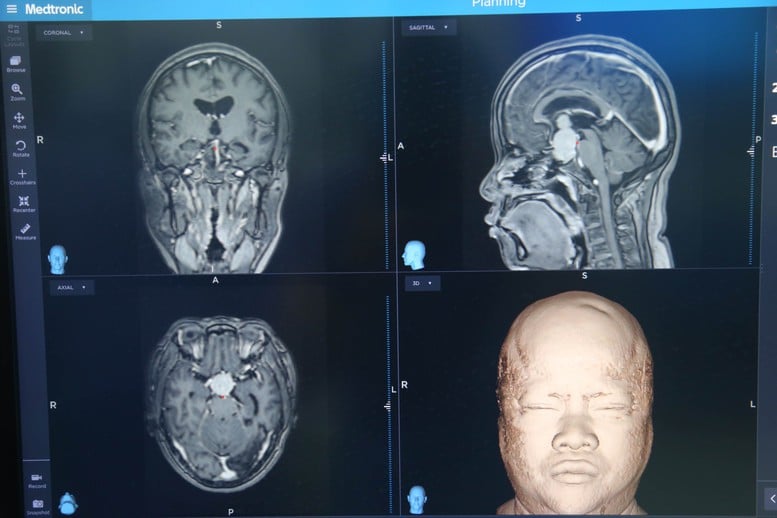 Pertama kali tumor pituitari diangkat melalui dua operasi besar sekaligus - Foto 3. Lần đầu tiên cắt bỏ u tuyến yên bằng 2 cuộc đại phẫu cùng lúc- Ảnh 3.
