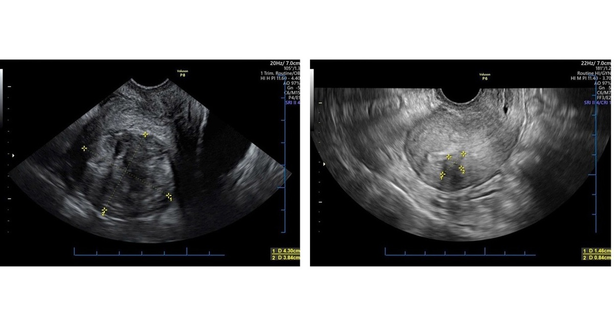 Điều trị u tử cung không xâm lấn, bảo tồn chức năng sinh sản