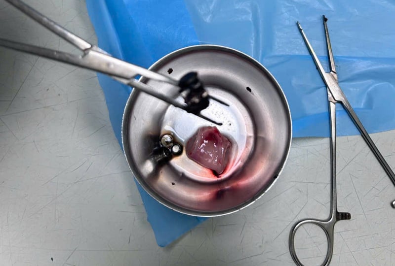 4-year-old boy in Can Tho swallowed 10 batteries and magnets -0