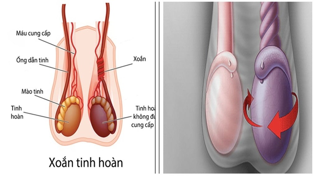 Đột ngột đau dữ dội vùng bìu, chàng trai 20 tuổi may mắn giữ được tinh hoàn - 1