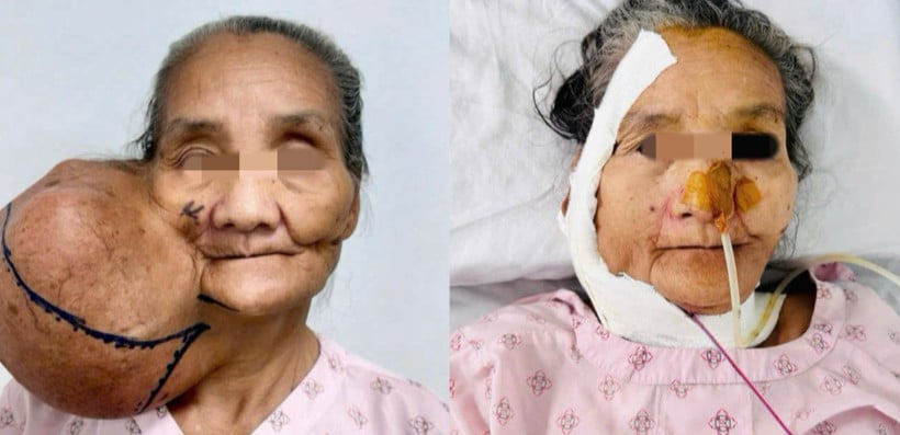 Pacient podstoupil operaci k odstranění obrovského nádoru.