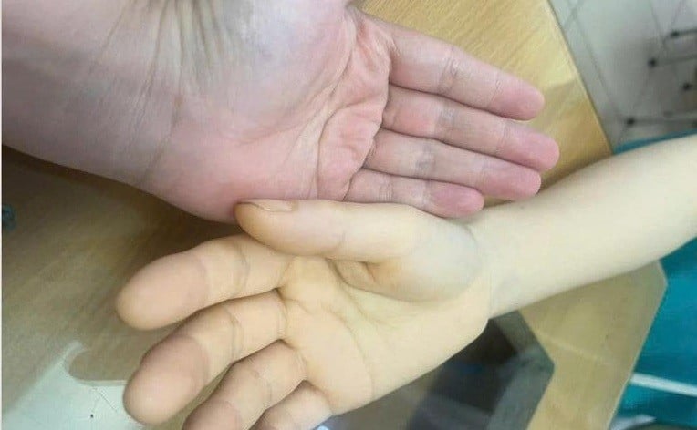 La main du patient (droite) présente une jaunisse due à une perte de sang.