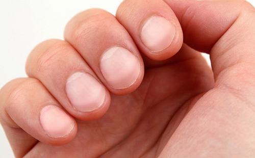 5 dấu hiệu trên móng tay có thể tiết lộ tình trạng sức khỏe của người nhiễm HIV- Ảnh 1.