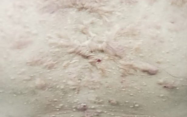 Sẹo lồi có tự hết không?