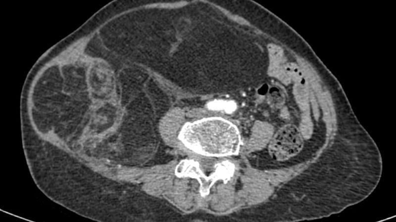 Imagem de tomografia computadorizada do abdômen do paciente.