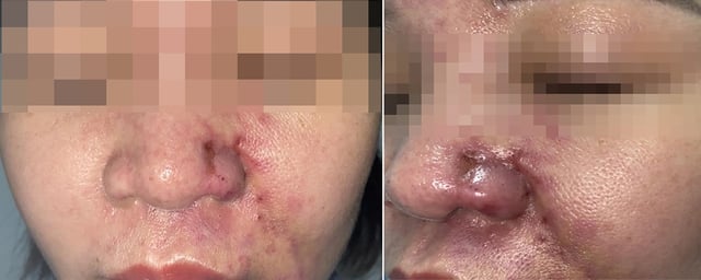 Multe tipuri de complicații cauzate de tratamente cosmetice nesigure - Fotografia 1. Muôn kiểu biến chứng do làm đẹp không an toàn- Ảnh 1.