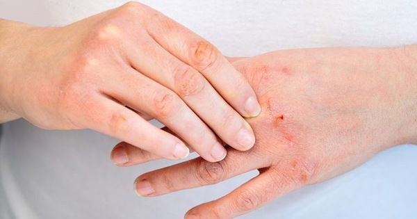 5 biện pháp hiệu quả giúp cải thiện tình trạng viêm da cơ địa