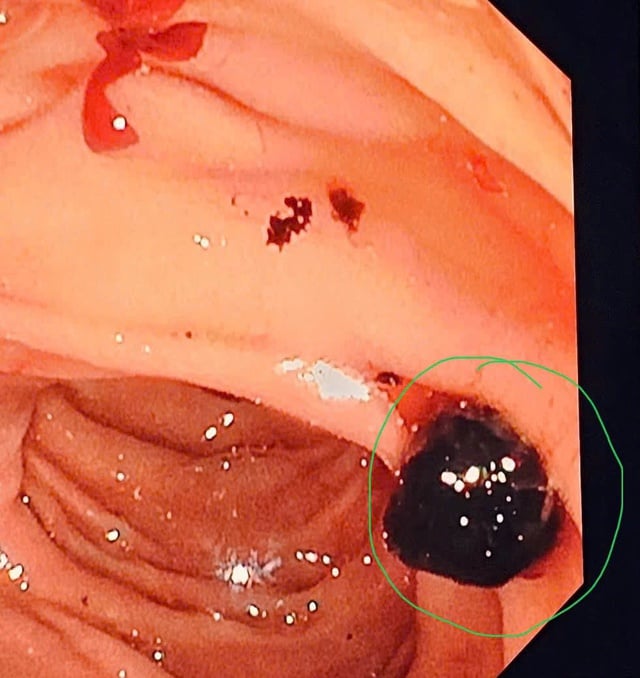 Provinční všeobecná nemocnice Thanh Hoa zvládla techniku intervenční endoskopické retrográdní cholangiopankreatografie (ERCP) - Foto 1. Bệnh viện Đa khoa tỉnh Thanh Hóa làm chủ kỹ thuật nội soi mật tụy ngược dòng can thiệp (ERCP)- Ảnh 1.
