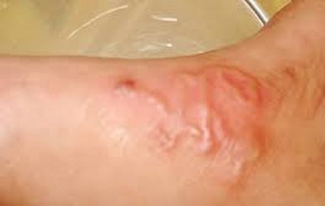 ករណីដង្កូវនាងឆ្កែជាច្រើននាក់នៅខេត្ត Khanh Hoa ប្រជាជនការពារយ៉ាងសកម្ម - រូបថត ២. Nhiều trường hợp ở Khánh Hòa bị sán chó, người dân chủ động phòng bệnh- Ảnh 2.