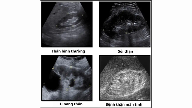 Böbrek yetmezliği ultrasonla tespit edilebilir mi? Hemen öğrenin! - Fotoğraf 2. Suy thận siêu âm có ra không? Tìm hiểu ngay để biết!- Ảnh 2.