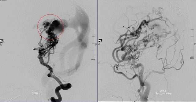 10-årig flicka övervinner 8 cerebrovaskulära ingrepp, drömmer om att bära en vit rock - Foto 1. Cô bé 10 tuổi vượt qua 8 lần can thiệp mạch máu não, mơ ước khoác áo blouse trắng- Ảnh 1.