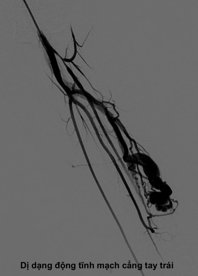 Tê đau ngón tay cái, cô gái bất ngờ phát hiện căn bệnh hiếm gặp- Ảnh 2.