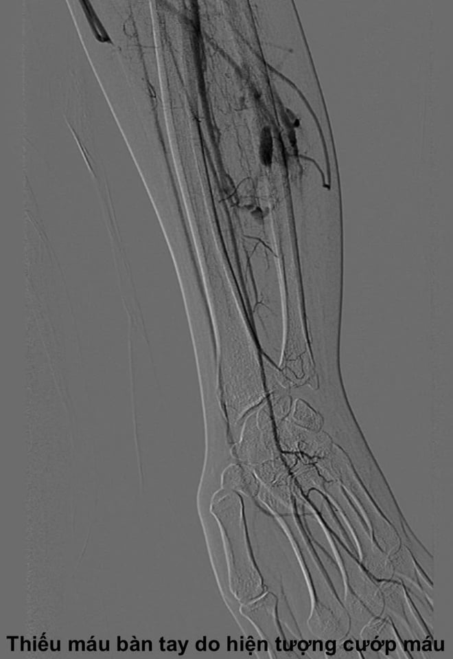 Tê đau ngón tay cái, cô gái bất ngờ phát hiện căn bệnh hiếm gặp- Ảnh 3.