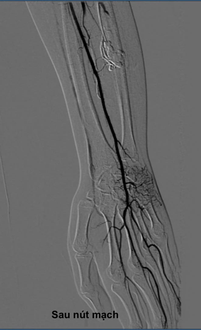 Tê đau ngón tay cái, cô gái bất ngờ phát hiện căn bệnh hiếm gặp- Ảnh 4.