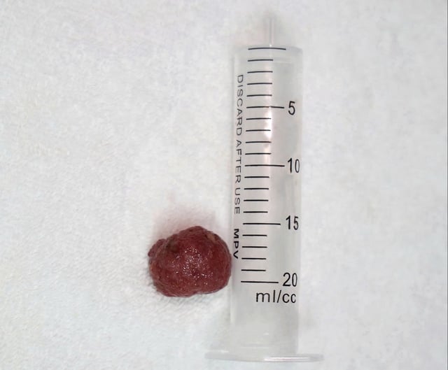 Saving a 13-year-old boy with intussusception by removing a large colon polyp - Photo 3. Cứu bé trai 13 tuổi bị lồng ruột nhờ loại bỏ polyp đại tràng lớn- Ảnh 3.