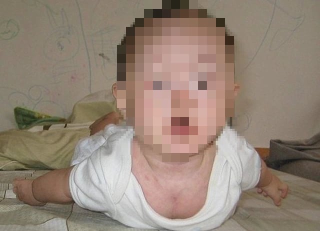 Trẻ mệt bất thường có thể mắc rối loạn nhược cơ bẩm sinh- Ảnh 2.