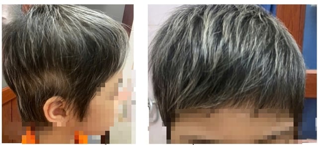 Bé gái 7 tuổi rụng hết tóc bất ngờ mọc kín đầu sau một năm- Ảnh 2.