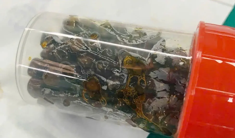 Spitalul Universitar Shing Mark a efectuat o intervenție chirurgicală laparoscopică pentru a îndepărta peste 100 de calculi biliari din vezica biliară a unei paciente.