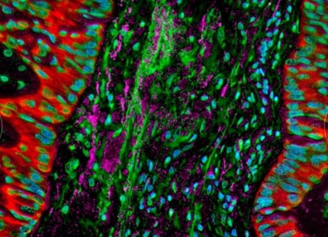 Este posibil să se vindece cancerul prin ajustarea microbiotei din țesutul tumoral? - Foto 1. Liệu có thể chữa ung thư bằng cách điều chỉnh vi sinh trong mô u?- Ảnh 1.