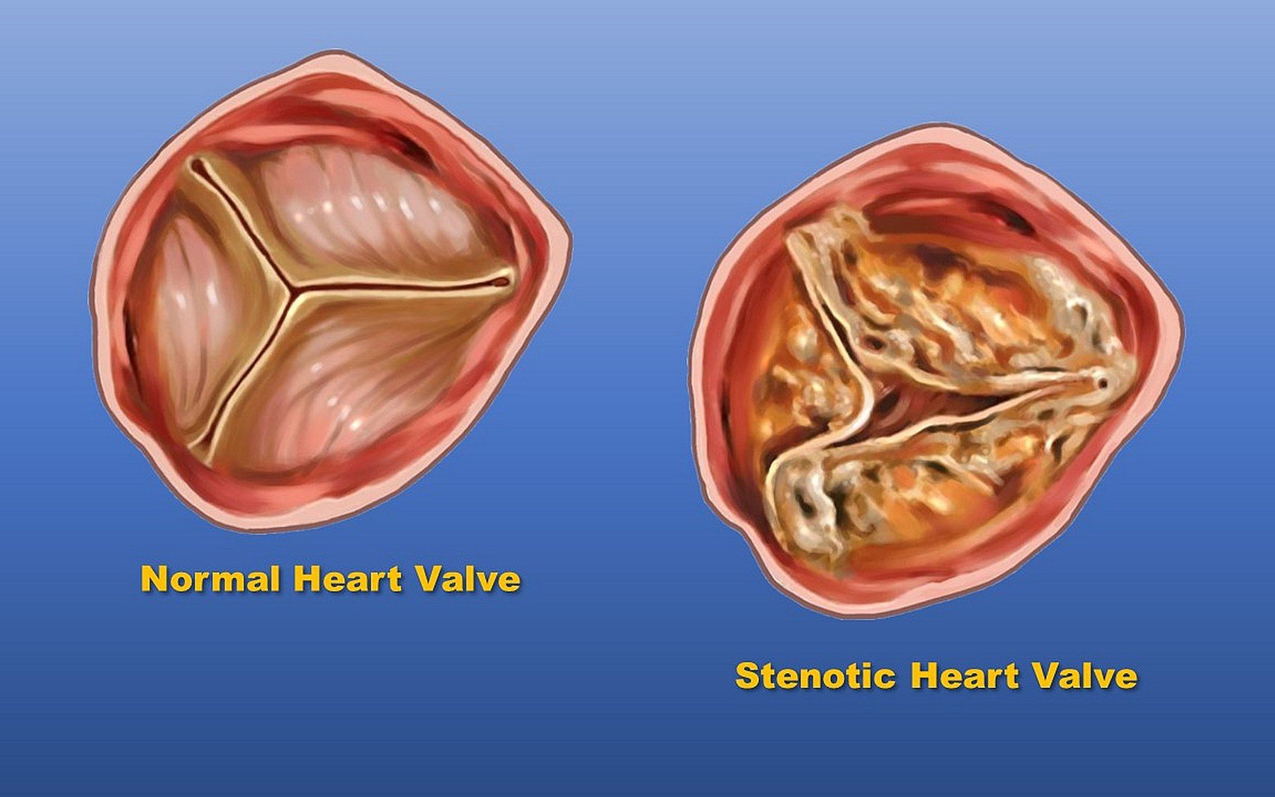 Pria berusia 80 tahun itu pusing, kesulitan bernapas, dan langsung pingsan. Dokter menemukan bahwa ia menderita stenosis katup aorta - Foto 2. Một số câu hỏi thường gặp về hẹp van động mạch chủ