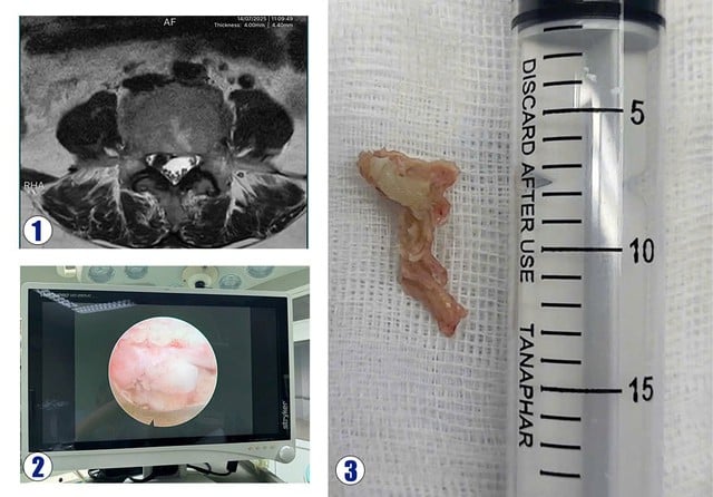 Phẫu thuật nội soi cột sống: Giải pháp điều trị an toàn, thẩm mỹ- Ảnh 2.