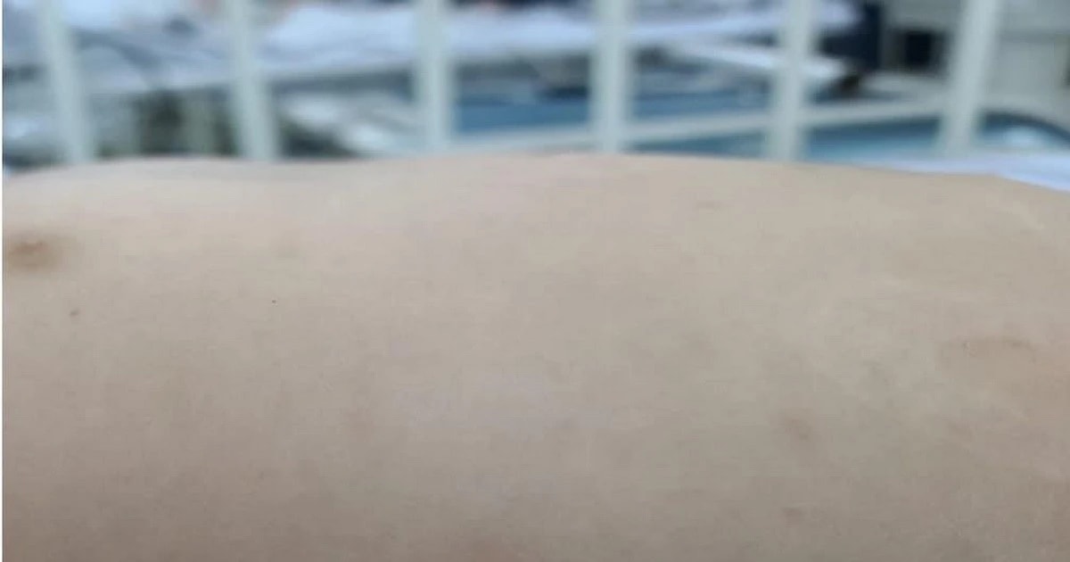 Cảnh báo về bệnh sốt mò dễ nhầm với cúm, có thể gây tổn thương gan, viêm màng não