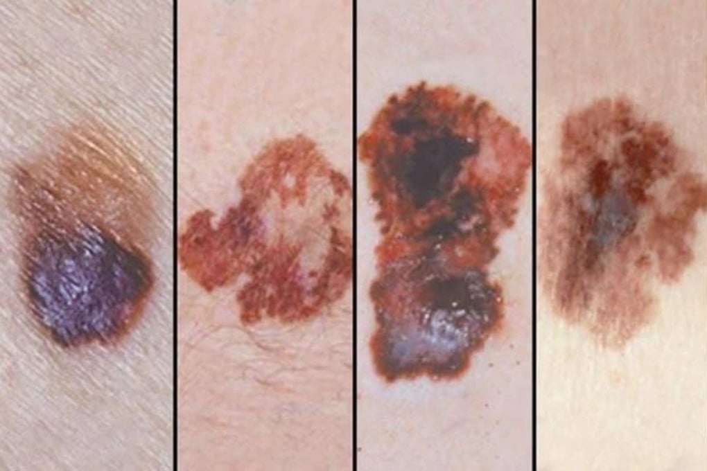 Für welche Krebsarten ist das russische Medikament Pembroria indiziert? - 2