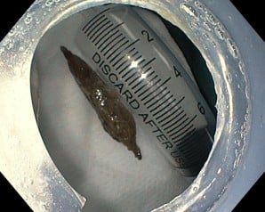 Ăn cháo yến, người phụ nữ bất ngờ bị hạt táo đỏ đâm thủng thành dạ dày- Ảnh 2.