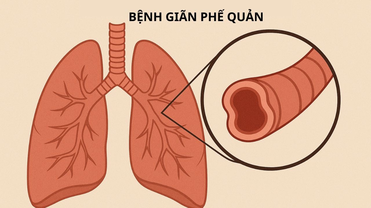 Ho ra máu cần cảnh giác với giãn phế quản- Ảnh 1.