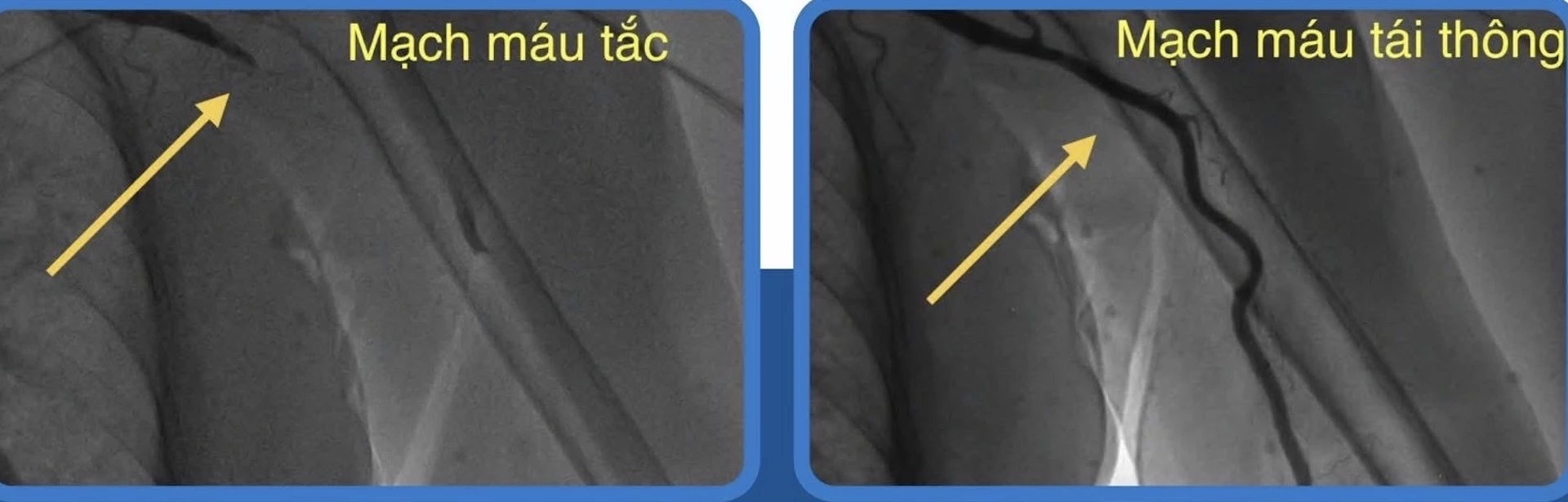 Hình ảnh trước và sau dòng máu được tái thông