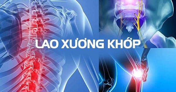 Ai là người dễ bị lao xương khớp?