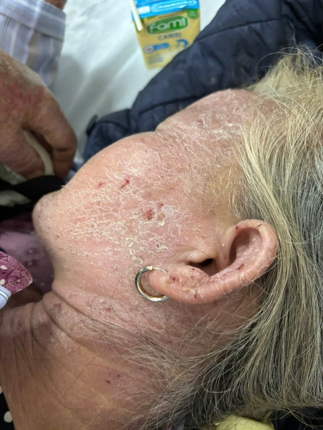 Žena si myslela, že má „červa“, a tak se sama léčila tabákem, téměř v kritickém stavu - Foto 2. Tưởng có 'sâu bò', người phụ nữ tự điều trị bằng thuốc lá, suýt nguy kịch- Ảnh 2.