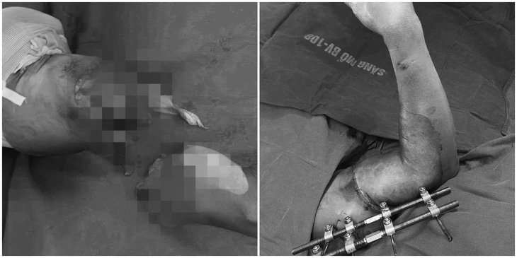 5 timmars operation för att cánh tay - Ảnh 1.