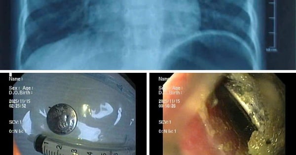 Bé trai ở Hải Phòng bị loét thực quản nặng vì nuốt pin cúc áo